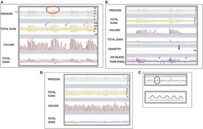 Ventilator integrated polygraphy for patients using non-invasive ventilation; Case report